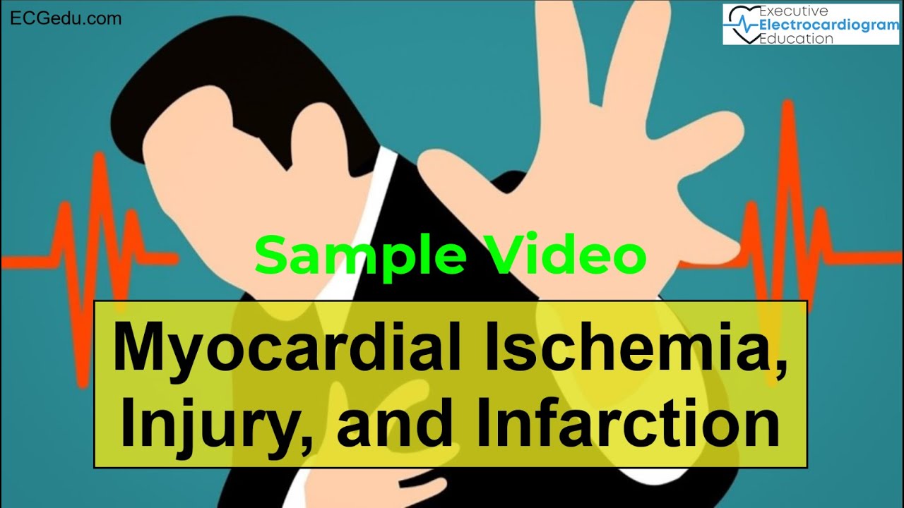 Myocardial Ischemia and Infarction on ECGs