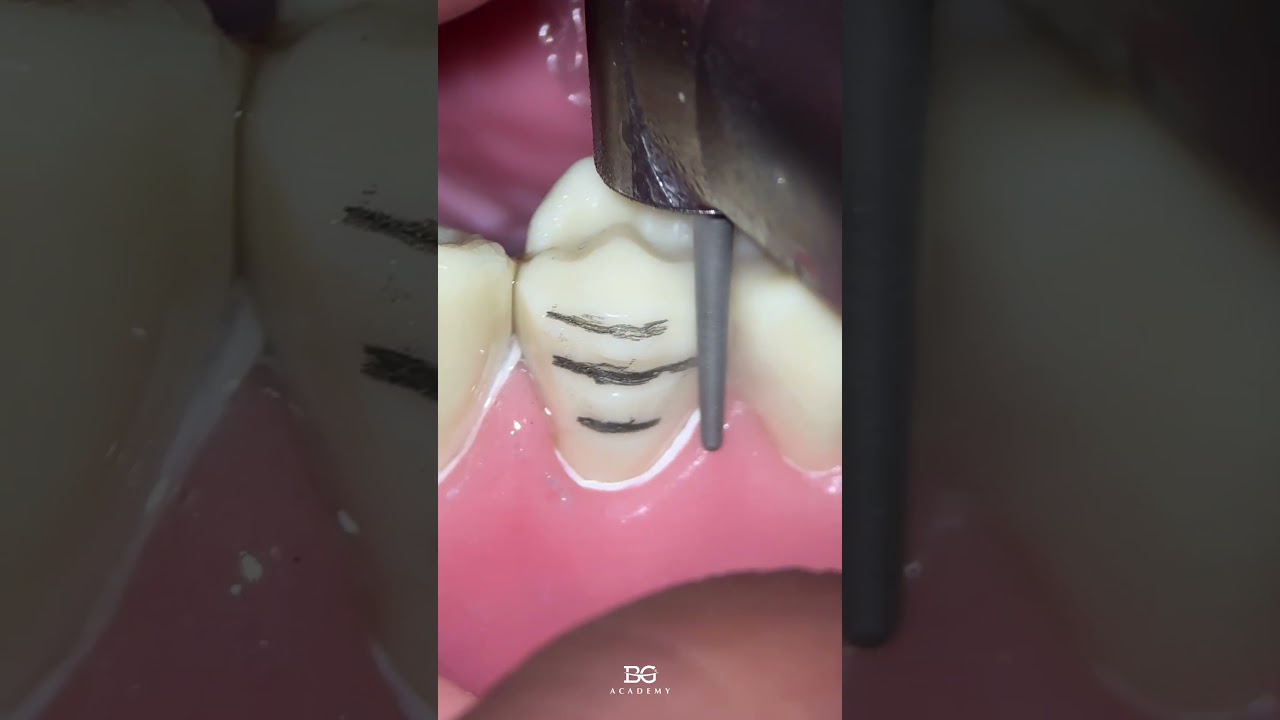 Premolar veneer prep. #veneer #preparation #preps