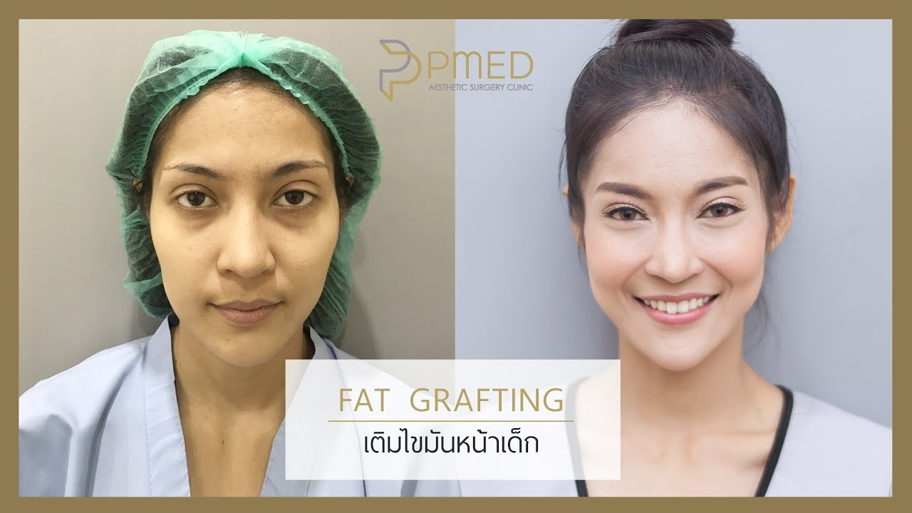 ฉีดไขมันเต็มเติมปรับรูปหน้า คุณเรย์ มิสซูปร้า Fat Grafting ที่พีเมด คลินิก