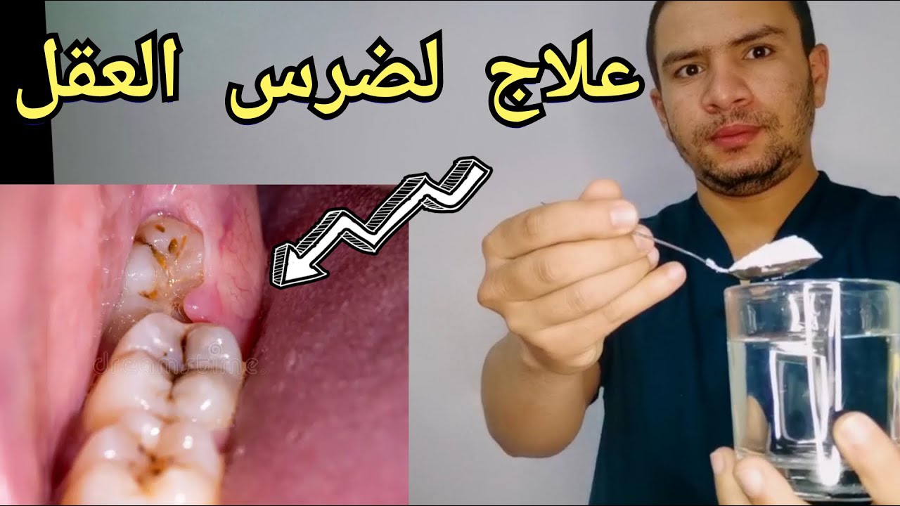 كيف توقف الم ضرس العقل بنفسك خلال دقائق