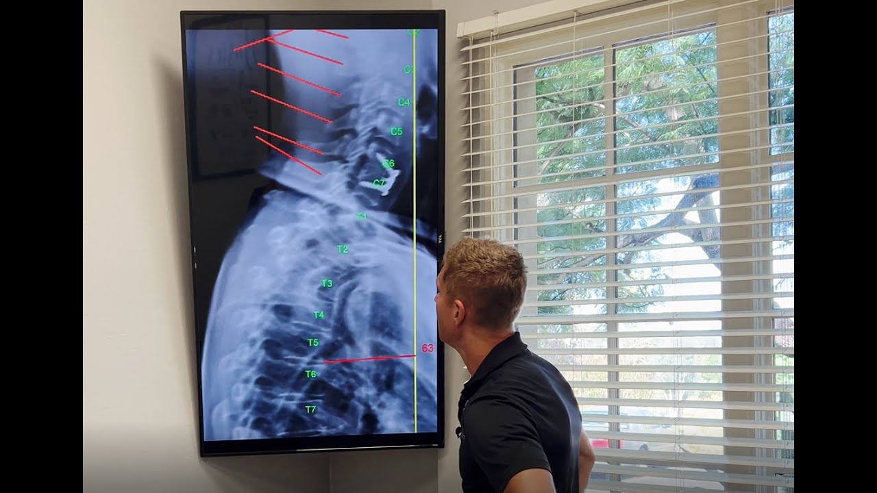 Cervical Surgical Fusion Adjustment - GONSTEAD Method