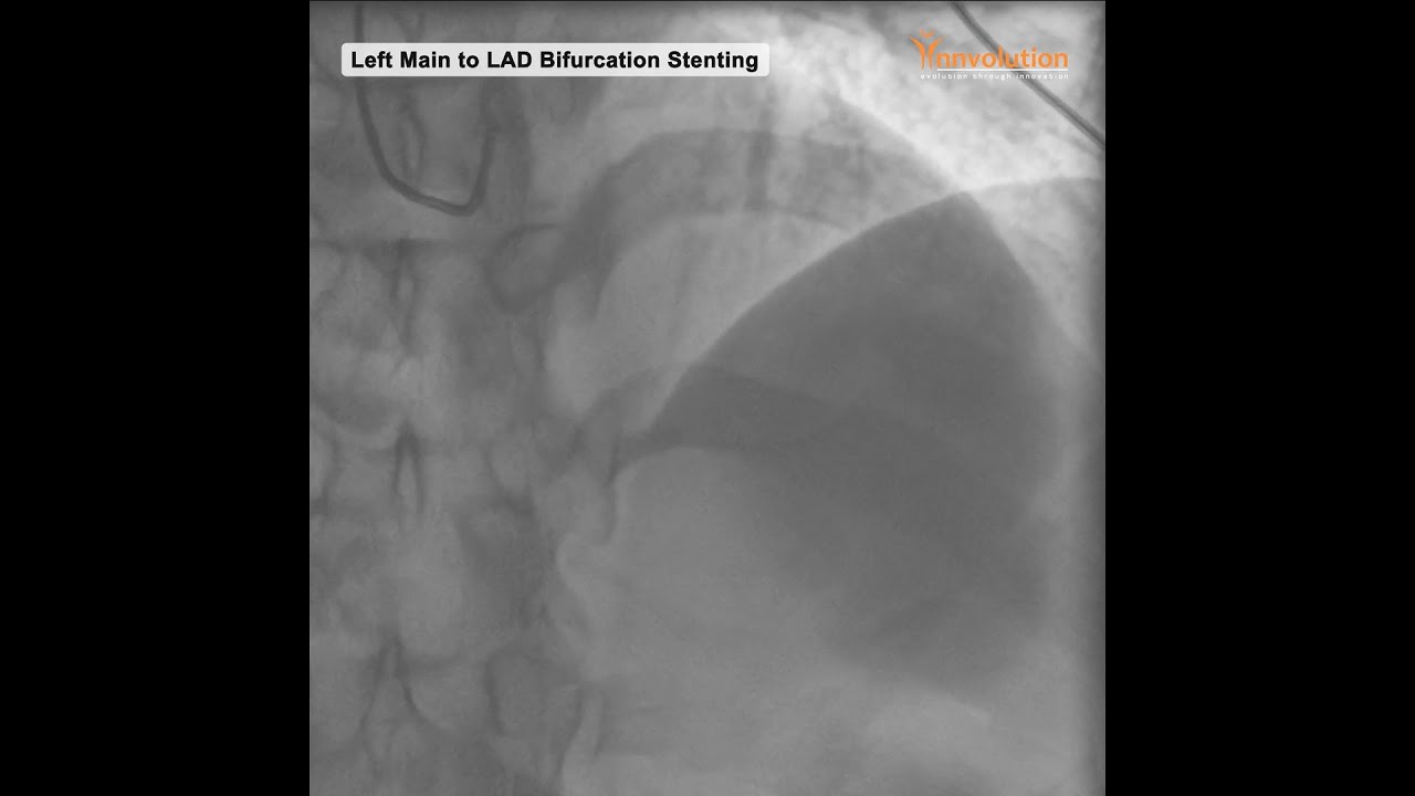 Left Main to LAD Bifurcation Stenting on Innvolution Cath Lab