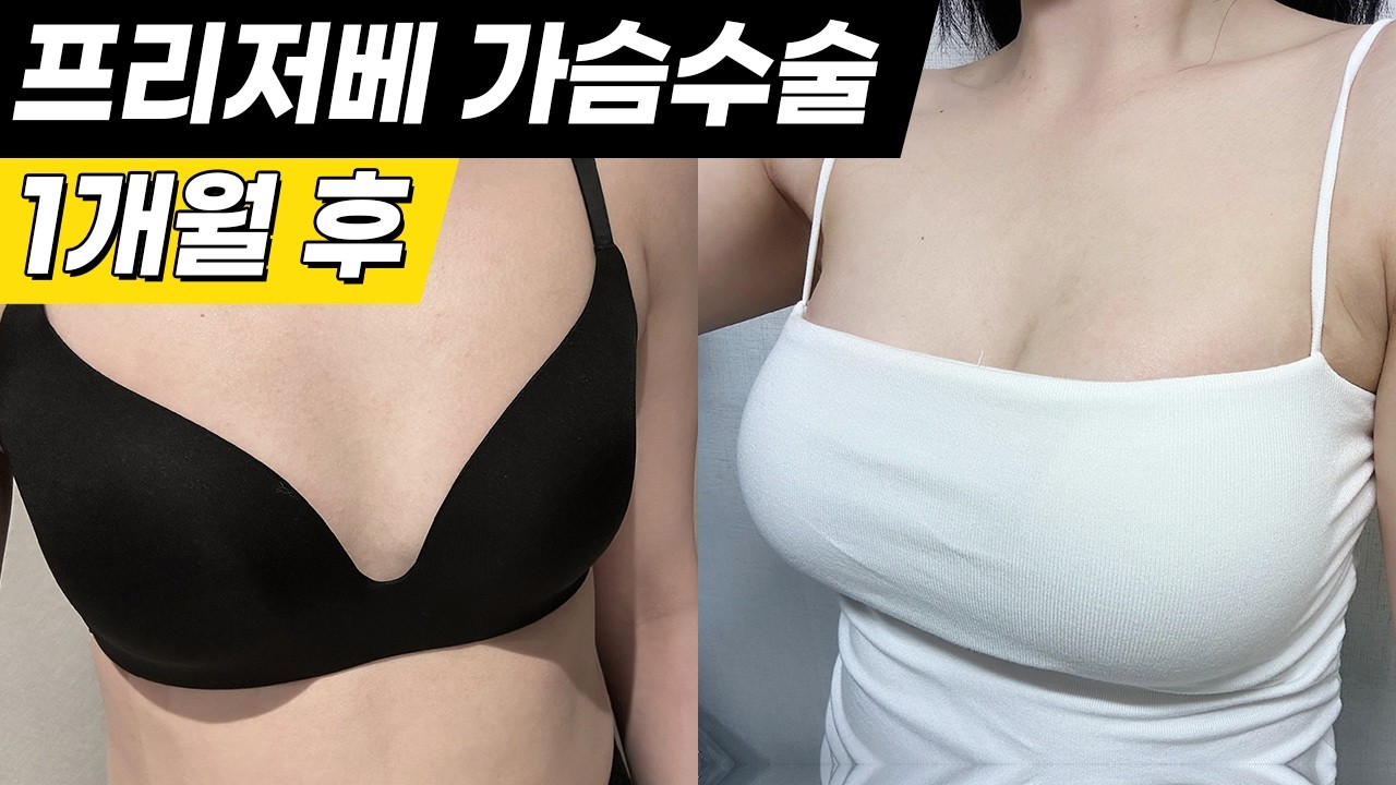 리얼모델 프리저베 가슴수술 후 1개월 인터뷰