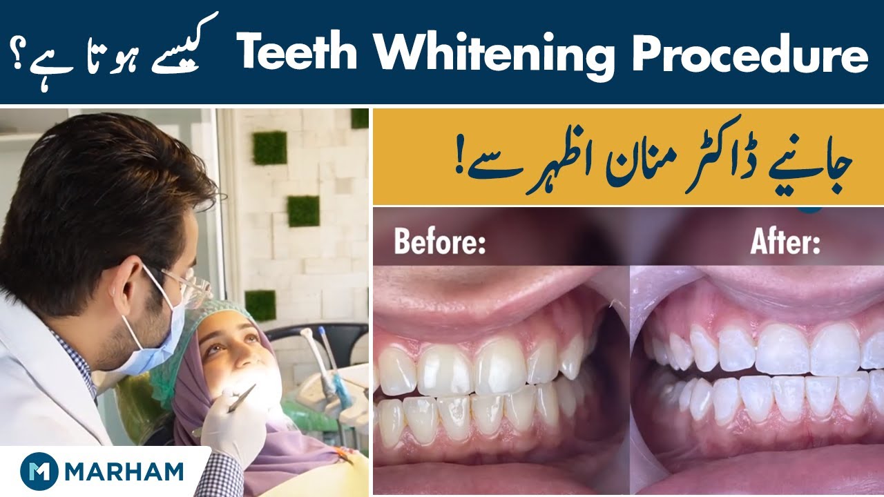 Teeth Whitening Procedure | Daanton Ko Safaid Karne Ka Tarika