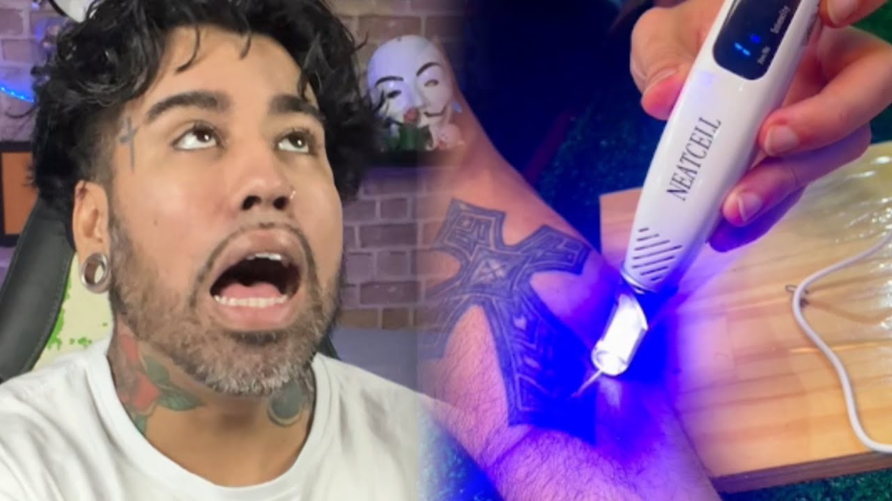 Removedor de Tatuagem laser  da shope