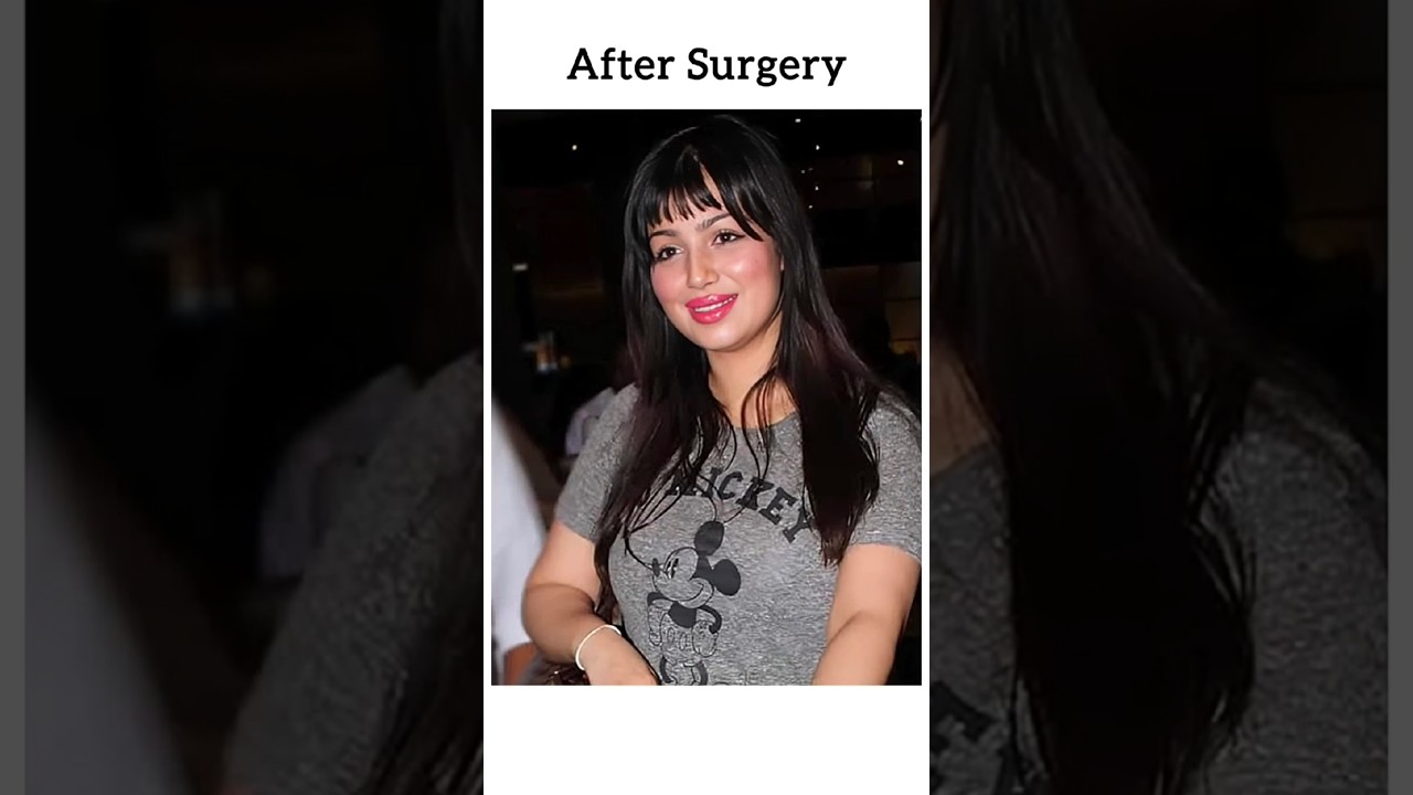 Ayesha Takia: Before & After Surgery 😲✨ | #bollywood #viralayshatakiya