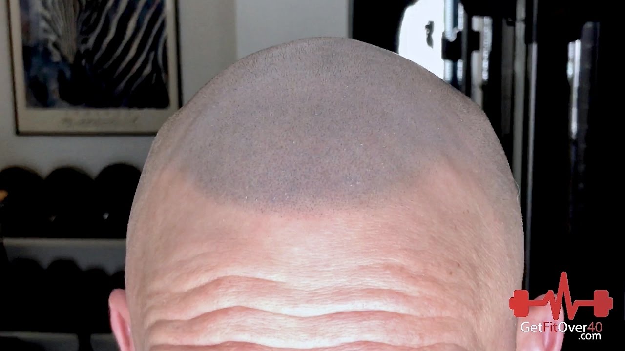 Getting Real Series - SMP Scalp Micropigmentation Final Results