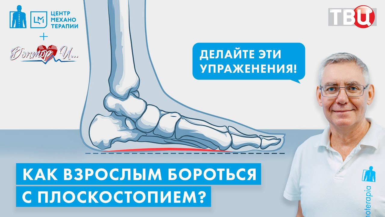Плоскостопие у взрослых. Как бороться? | Владимир Бондаренко для 