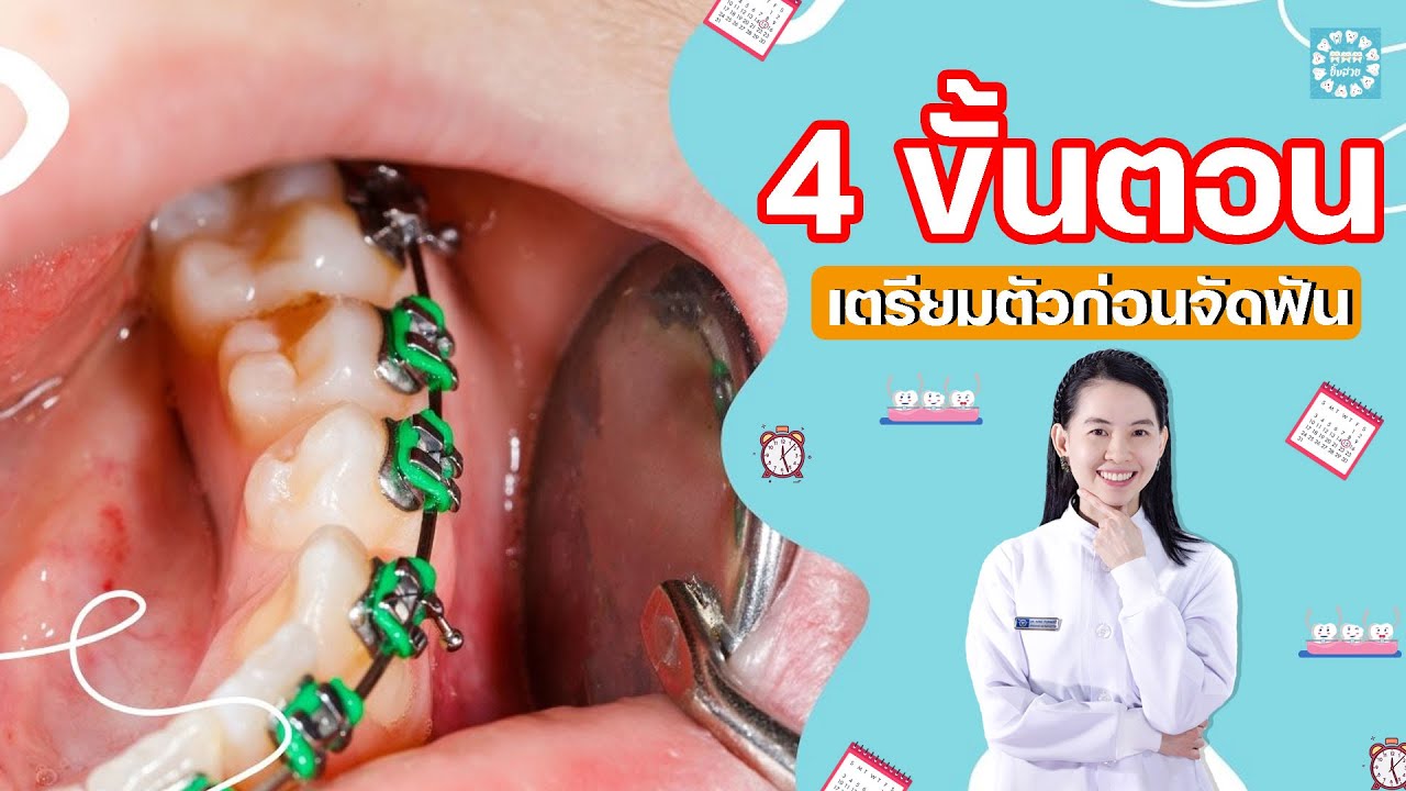 อยากจัดฟันต้องทำอะไรบ้าง 4 ขั้นตอน เตรียมตัวก่อนจัดฟัน
