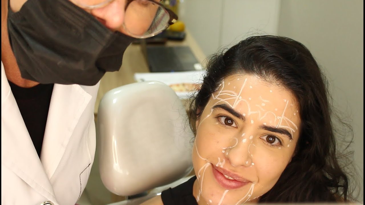 Botox full face na prática: marcação