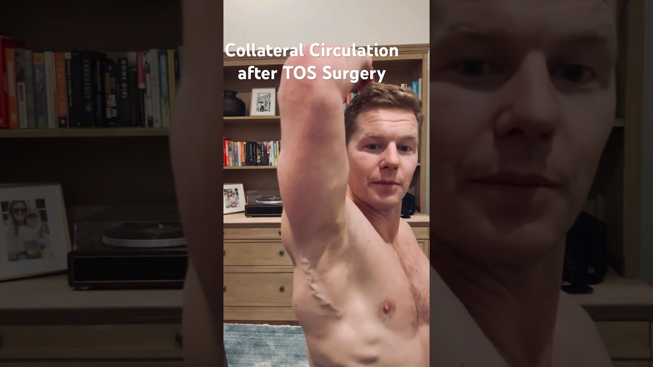 Collateral Blood Flow after my vTOS surgery! #tos #thoracicoutletsyndrome #humanbody