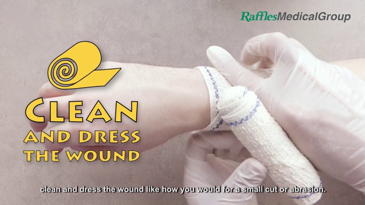 First Aid: How to Treat Burns