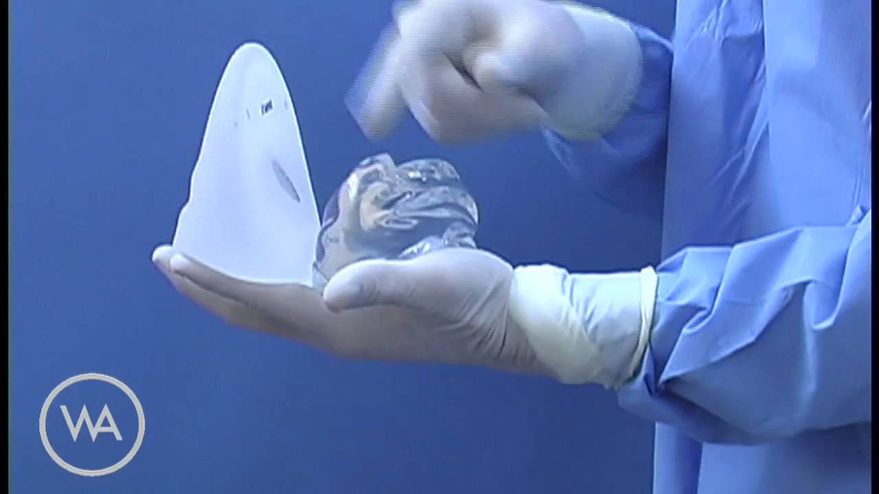 Cohesive Gel Breast Implants