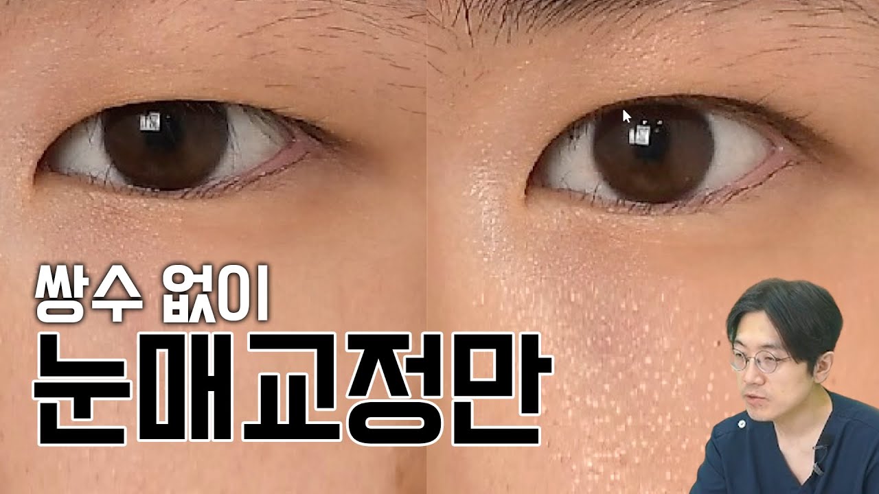 쌍수말고 눈매교정만 해주세요.