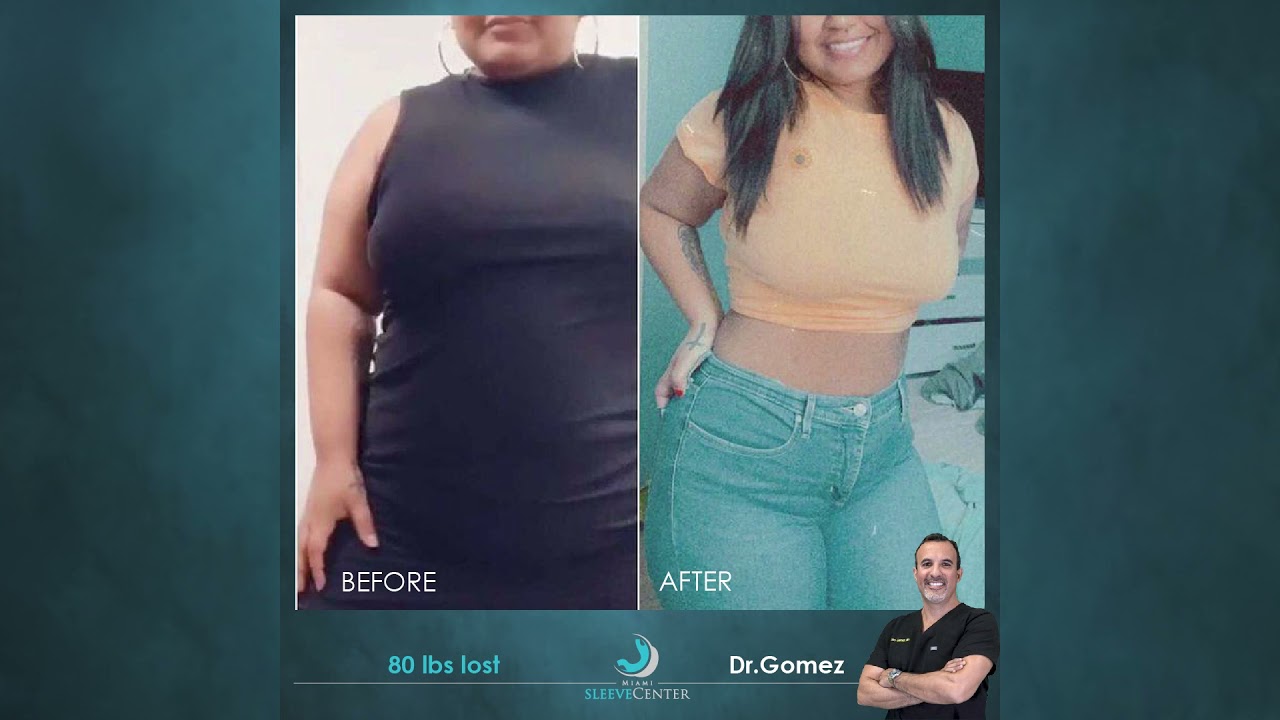 Gastric Sleeve - Before and After - Real Results  |  Miami Sleeve Center