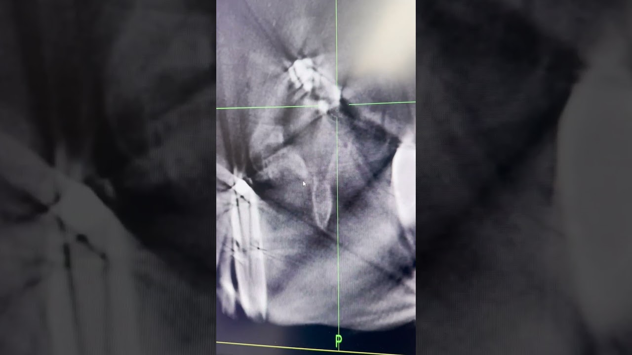 Laminectomy and Fusion L4-5 S-1