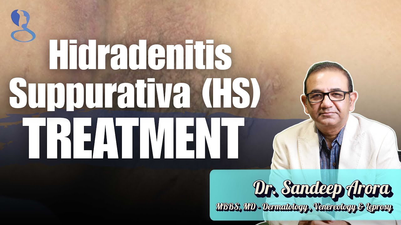 Hidradenitis Suppurativa | Treatment | Dr. Sandeep Arora | Lifestyle Changes, Laser & Biologics