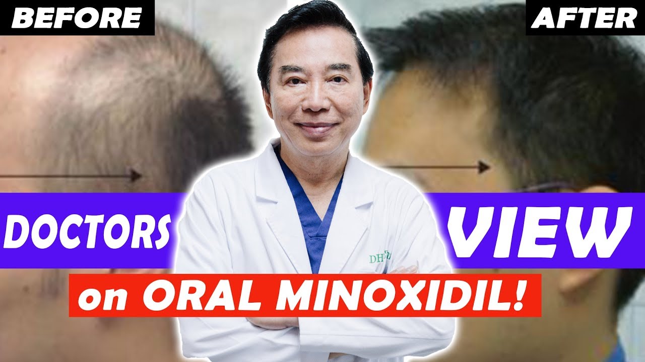 Doctor Reviews Oral Minoxidil for Hair Loss! Shares Before and After Result - Episode 3