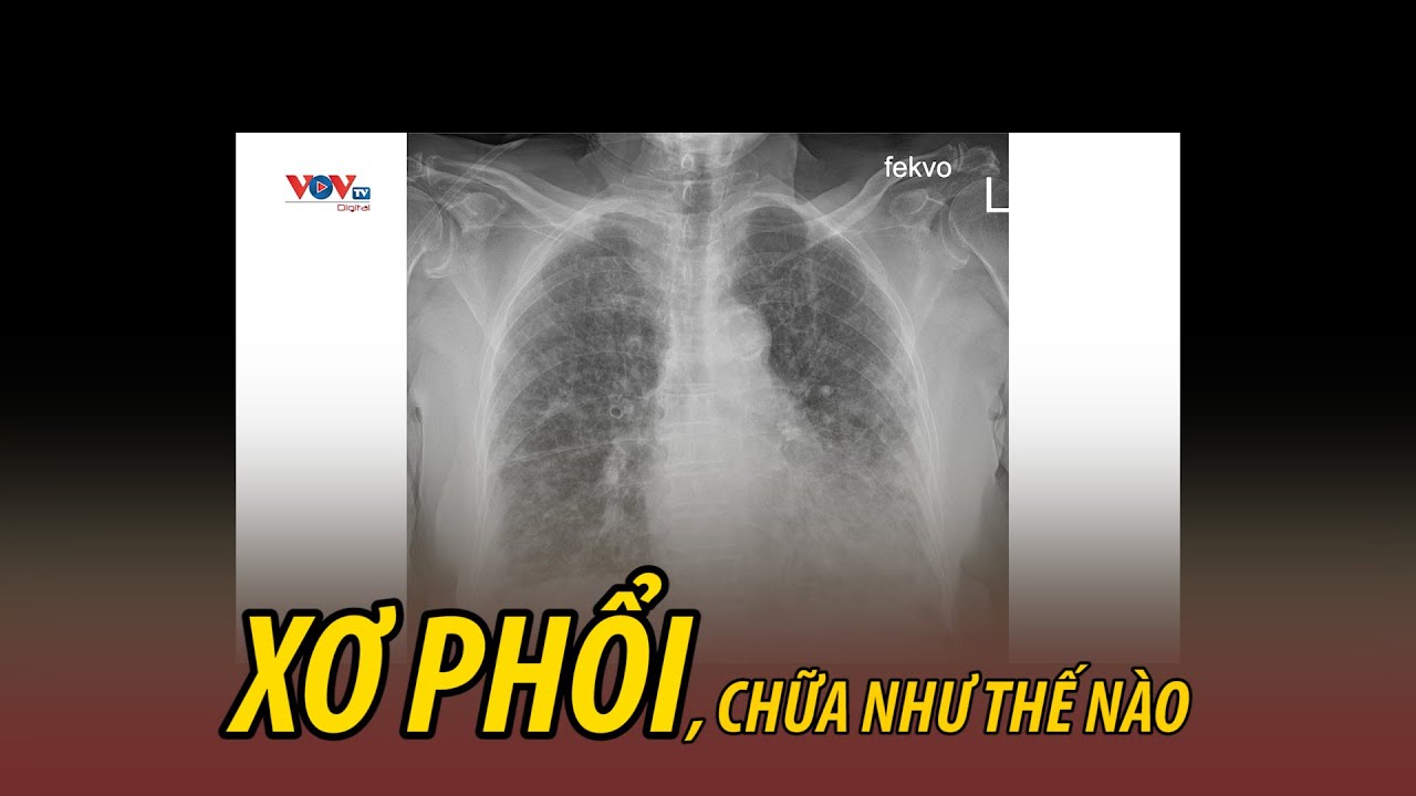 Xơ phổi, nguyên nhân và biện pháp điều trị | Sức khỏe là Vàng | VOVTV Sức khỏe