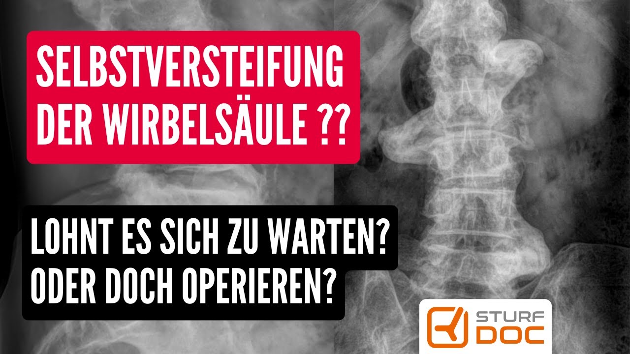 Selbstversteifung der Wirbelsäule - Lohnt es sich zu warten oder ist eine Operation besser?