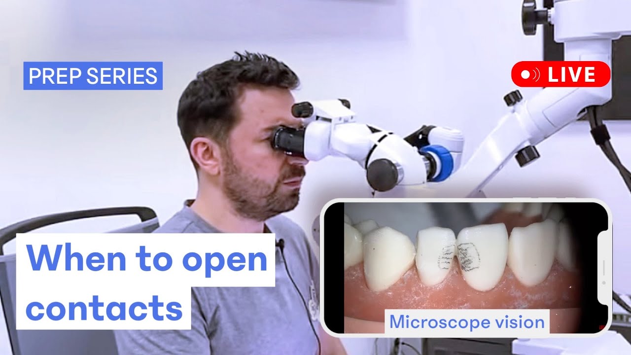 Veneer preps. When to open contacts