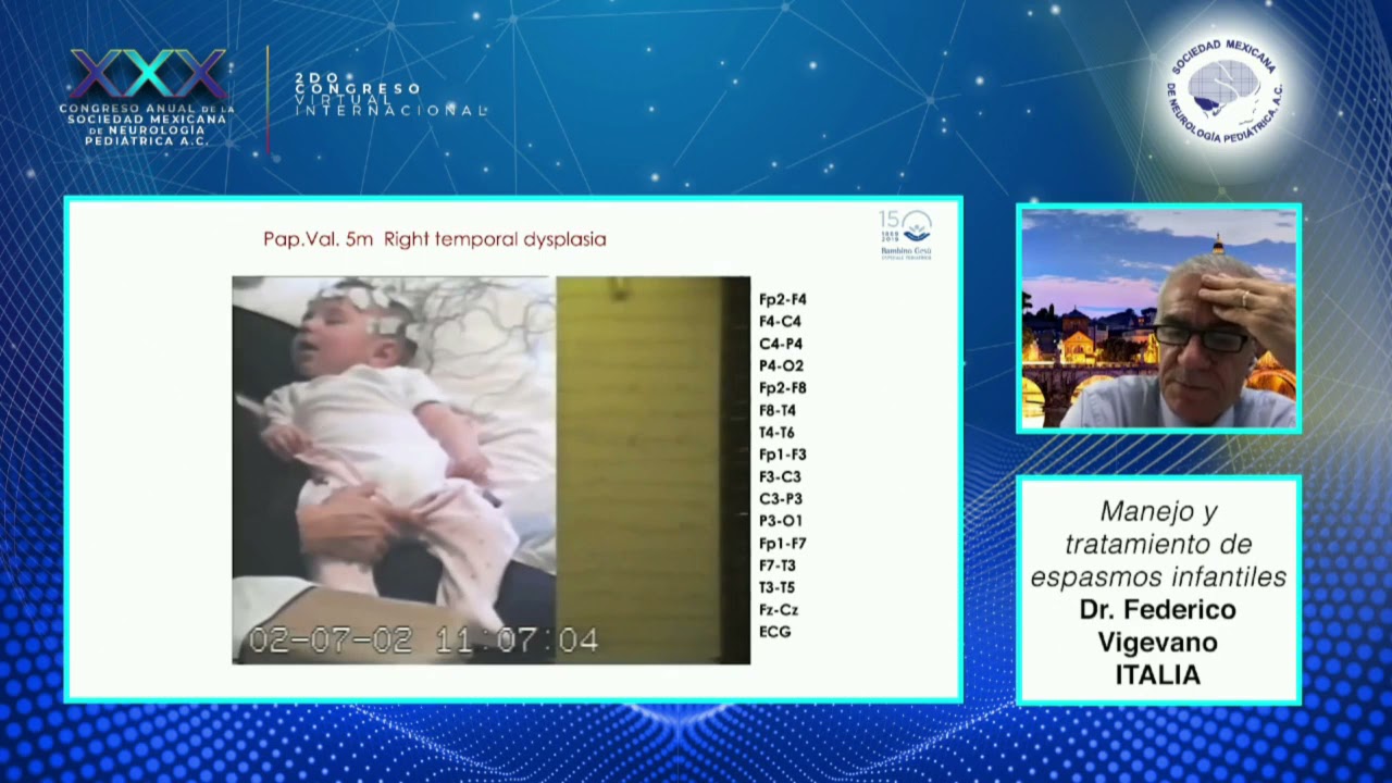 "Manejo y tratamiento de los espasmos infantiles"  Federico Vigevano traducido