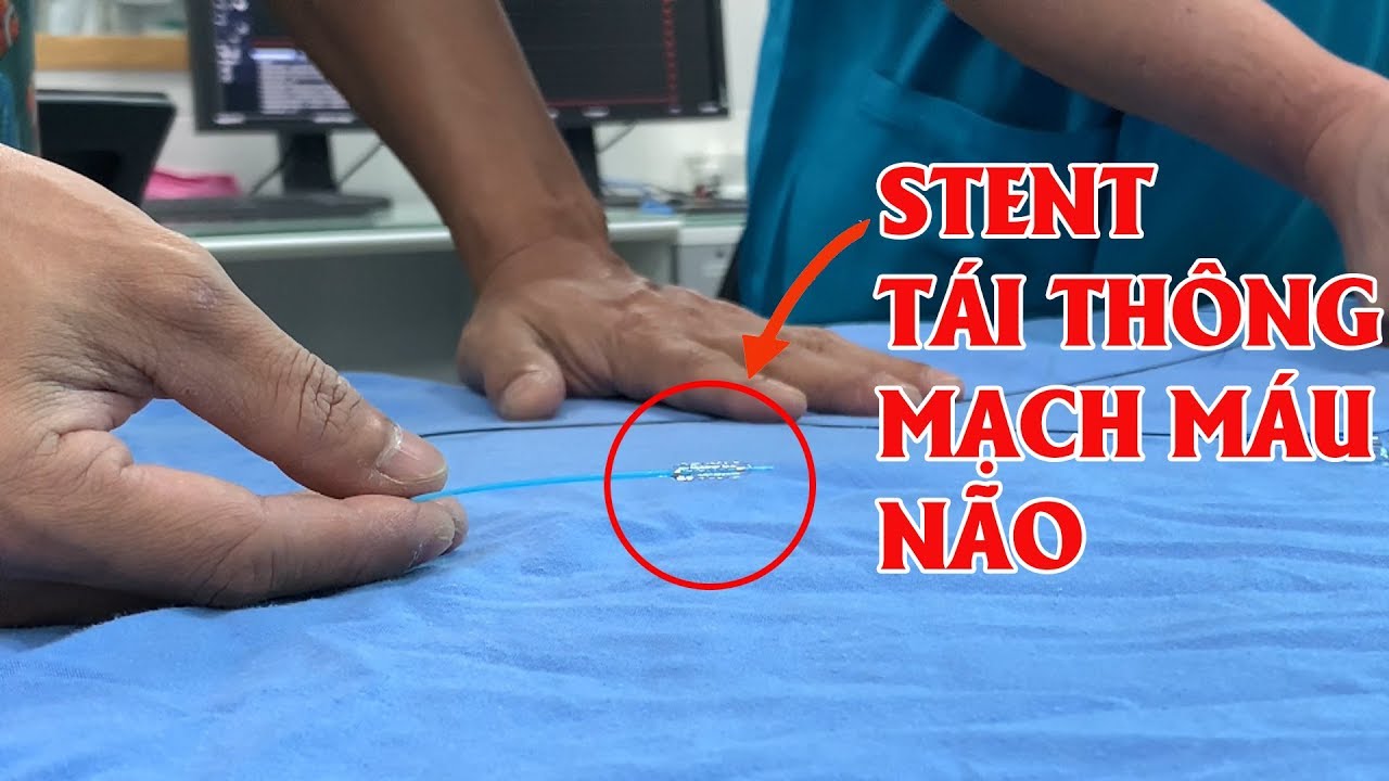Cận cảnh Stent 40 triệu chỉ dùng trong Can thiệp đột quỵ