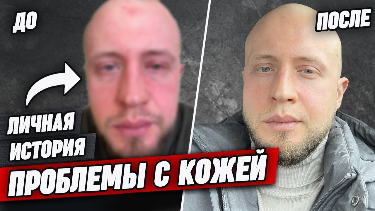 Как я вылечил ПРЫЩИ | Мужской уход за лицом | Потратил 400 000 на лечение кожи | Причины акне