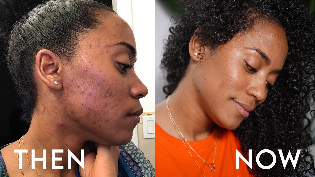 Goodbye Acne! Hello Face Reality Skincare | One Year Update!
