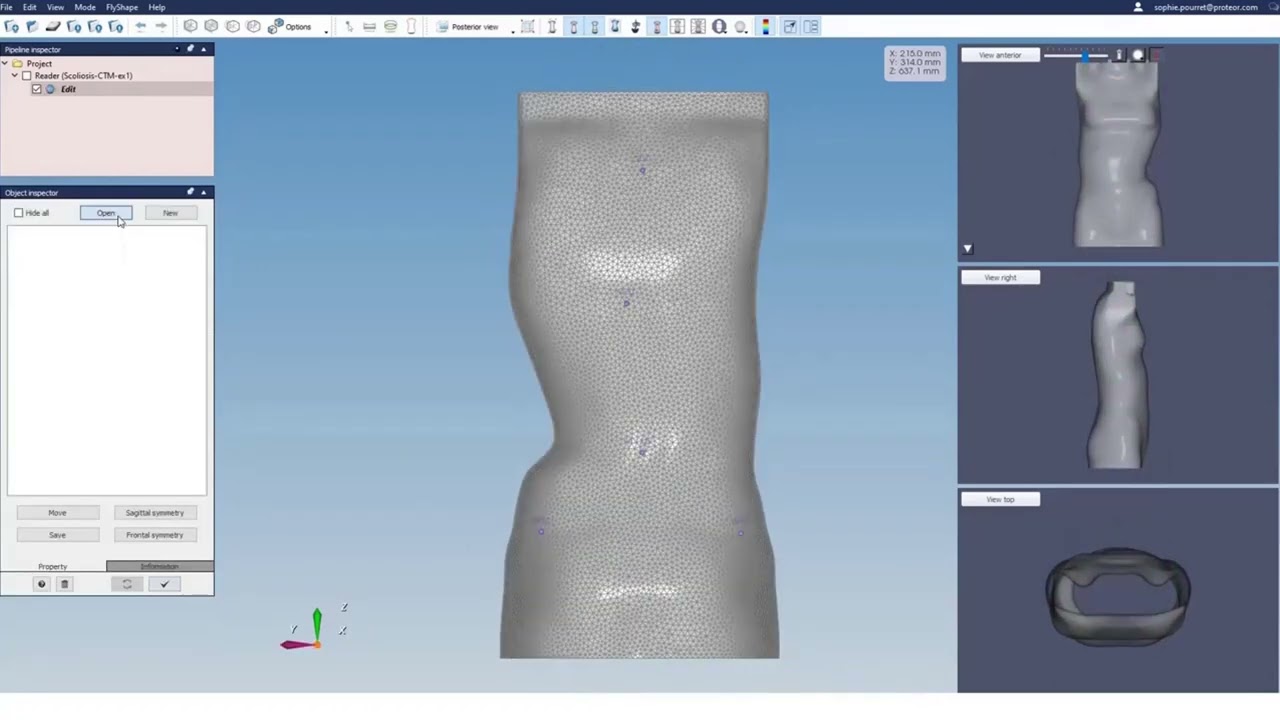 ORTENSHAPE - Scoliosis brace design