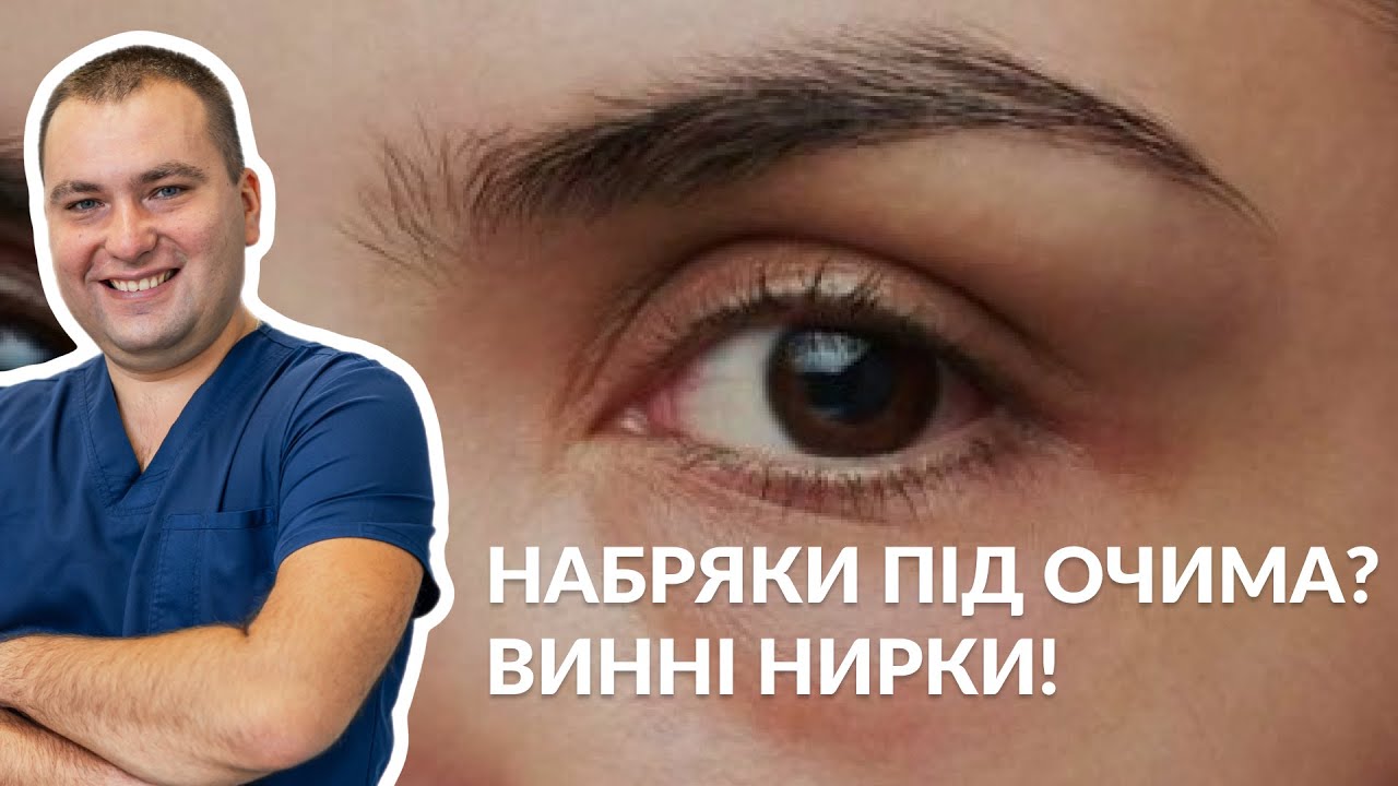 НАБРЯКИ ПІД ОЧИМА! ВИННІ НИРКИ? // Правда це чи міф відповідає лікар-уролог Валерій Камінський