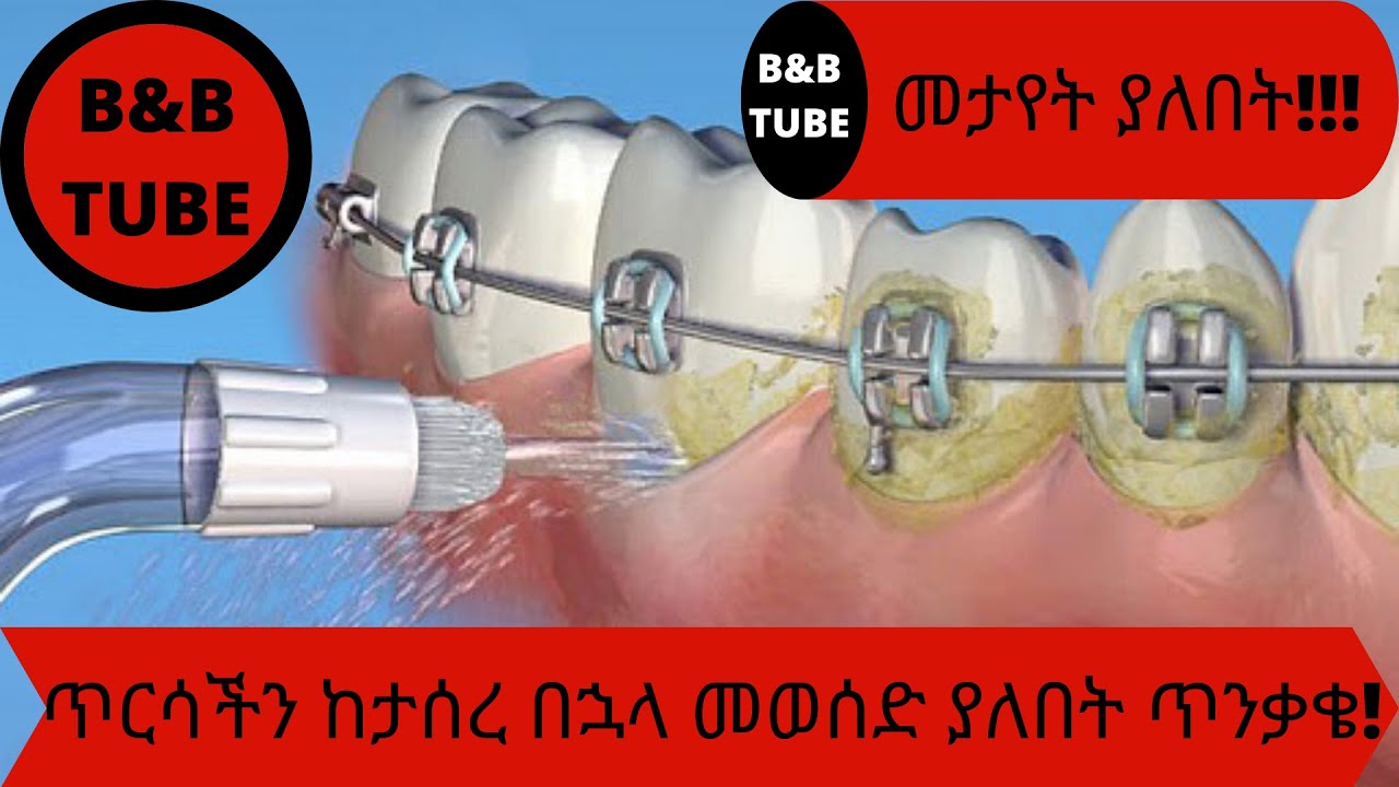 ጥርሳችን ከታሰረ በኋላ መወሰድ ያለበት ጥንቃቄ (ክፍል 3)