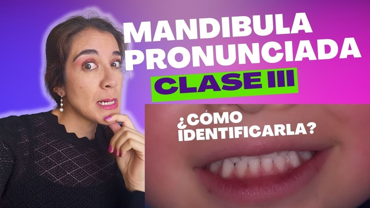 Mordida CRUZADA o Invertida, MANDÍBULA pronunciada, Clase 3 o Clase III, ¿Cómo identificarla?