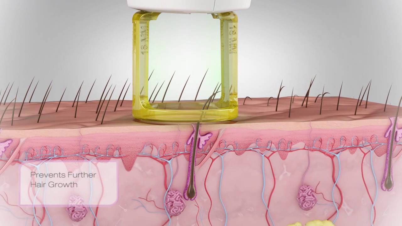 Depilaci&oacute;n Laser: C&oacute;mo act&uacute;a en la piel?