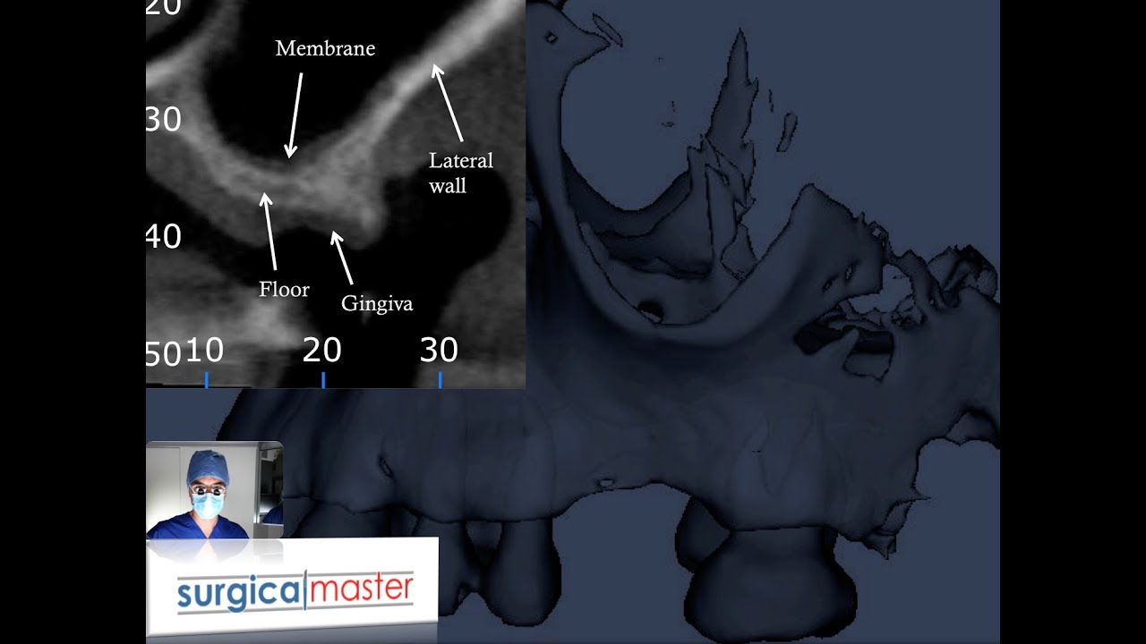 Tips for a sinus augmentation (SurgicalMaster™ advice)