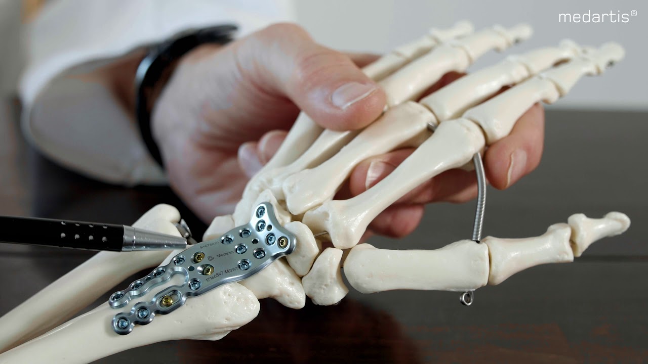 Feedback from the Market with Prof. Krimmer - Wrist Fusion with Transfix Screws