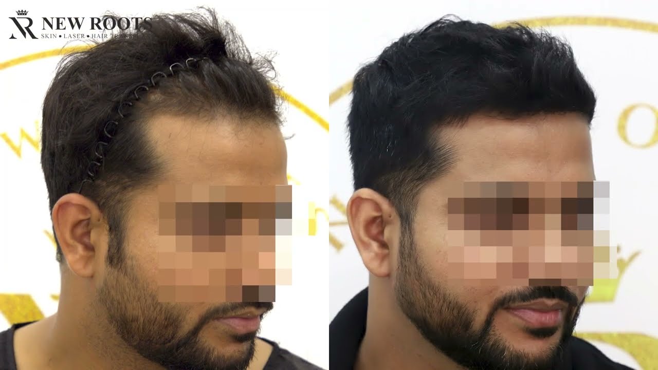 The Ultimate Undetectable Hairline Transformation | Hair Transplant Mumbai |
