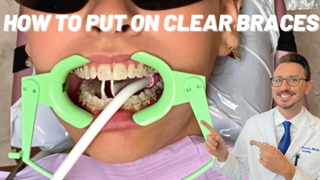 How to put Clear Braces on - Close up view - Ceramic Braces