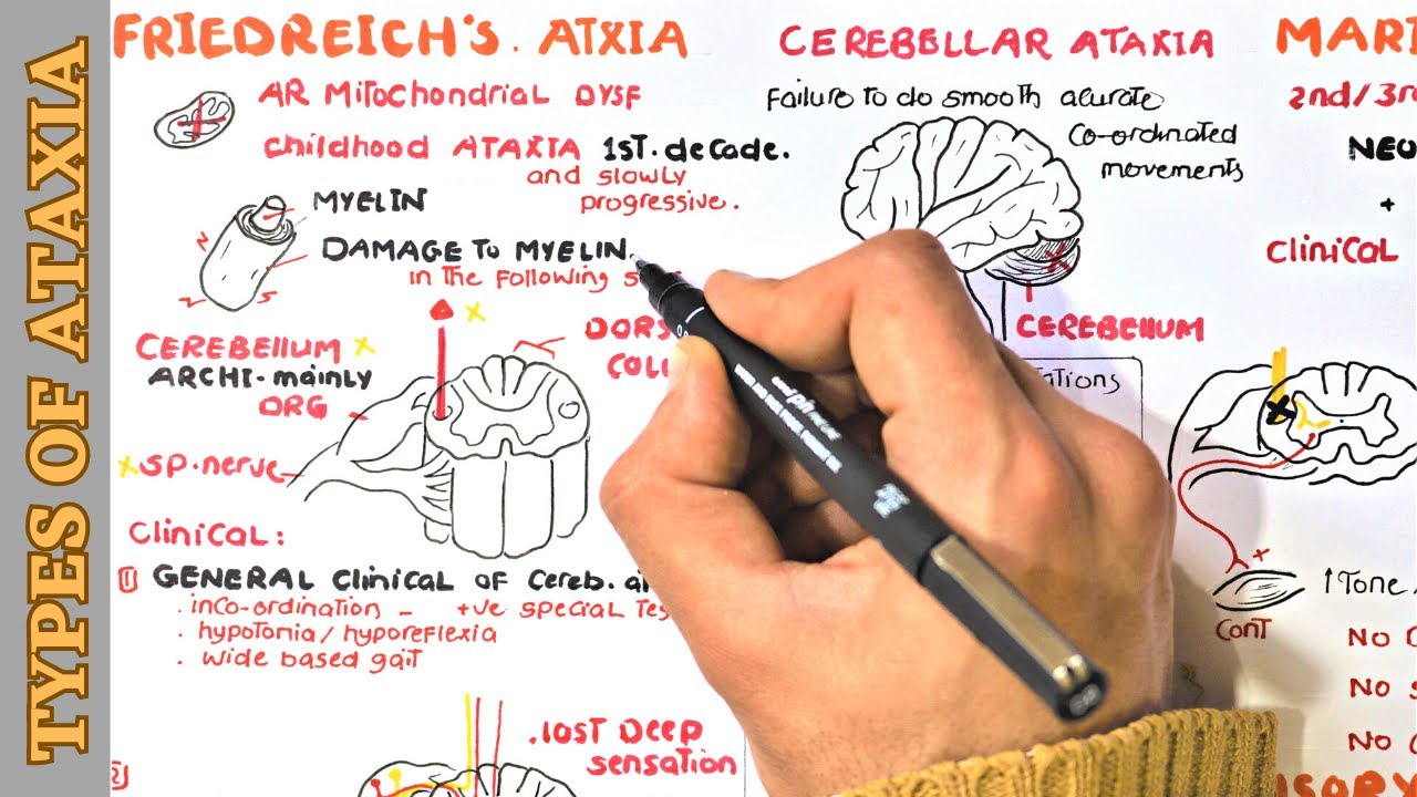 Cerebellar Ataxia ( Friedreich ataxia - Marie's ataxia ) and Sensory ataxia