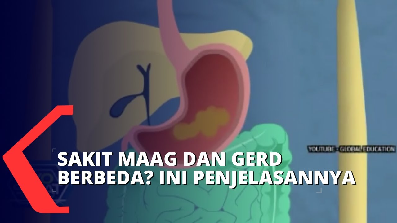Apa Perbedaan Maag dan Gerd? Begini Penjelasannya