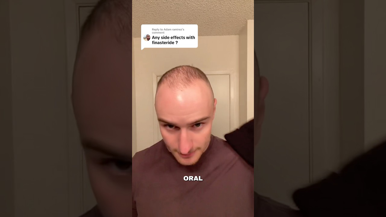 2 year finasteride update #hair #hairtransformation #hairgrowth #minoxidil #finasteride