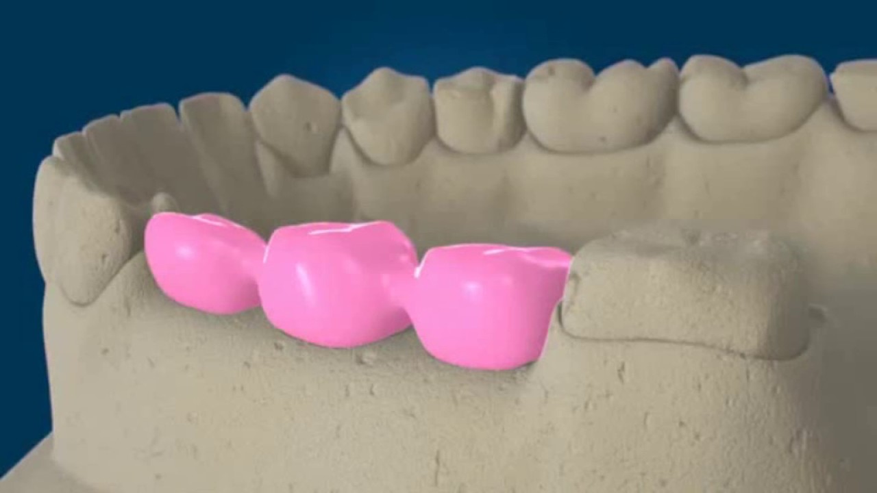 Prótese fixa de 3 elementos cimentada (sobre implantes dentários)