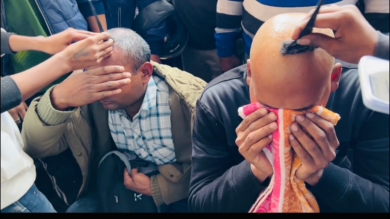 Alopecia Areata Hair Problam Solution Mr Salman Mandoli Chungi !! Hair patch Hair Fall !! Imranvlogs