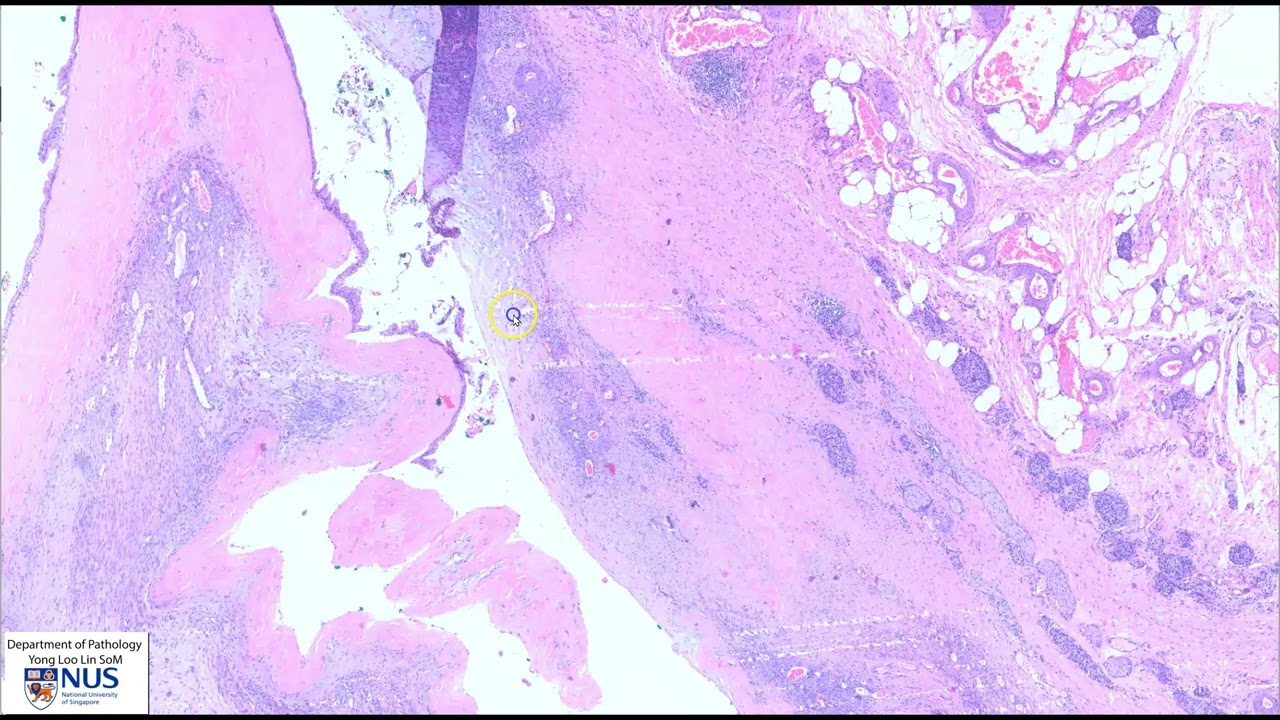Pancreas: Mucinous cystic neoplasm - Microscopy (Talking slide)