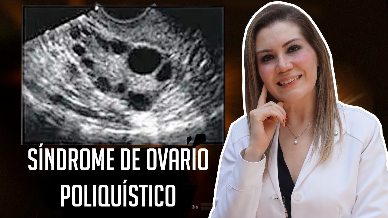 S&iacute;ndrome de ovario poliqu&iacute;stico &iquest;Sabes qu&eacute; es? - Dra Bere