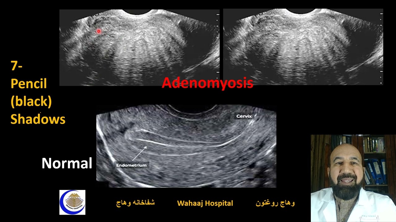 Adenomyosis Farsi اعلایم ادینومایوسس فارسی