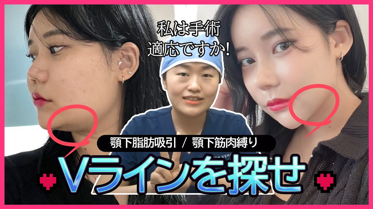 [ペリカン手術]顎下脂肪吸引と顎下筋肉縛り😮筋肉縛りは永久的⁉️