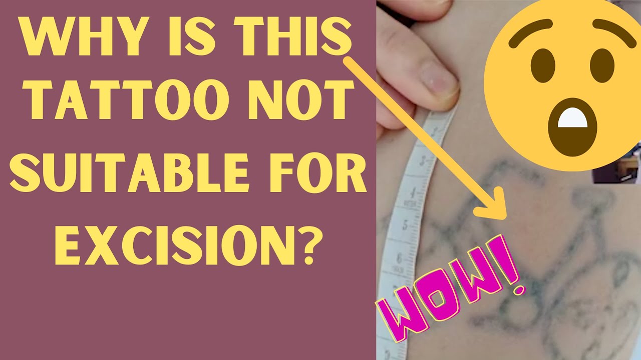 Why Is My Tattoo Not Suitable For Excision