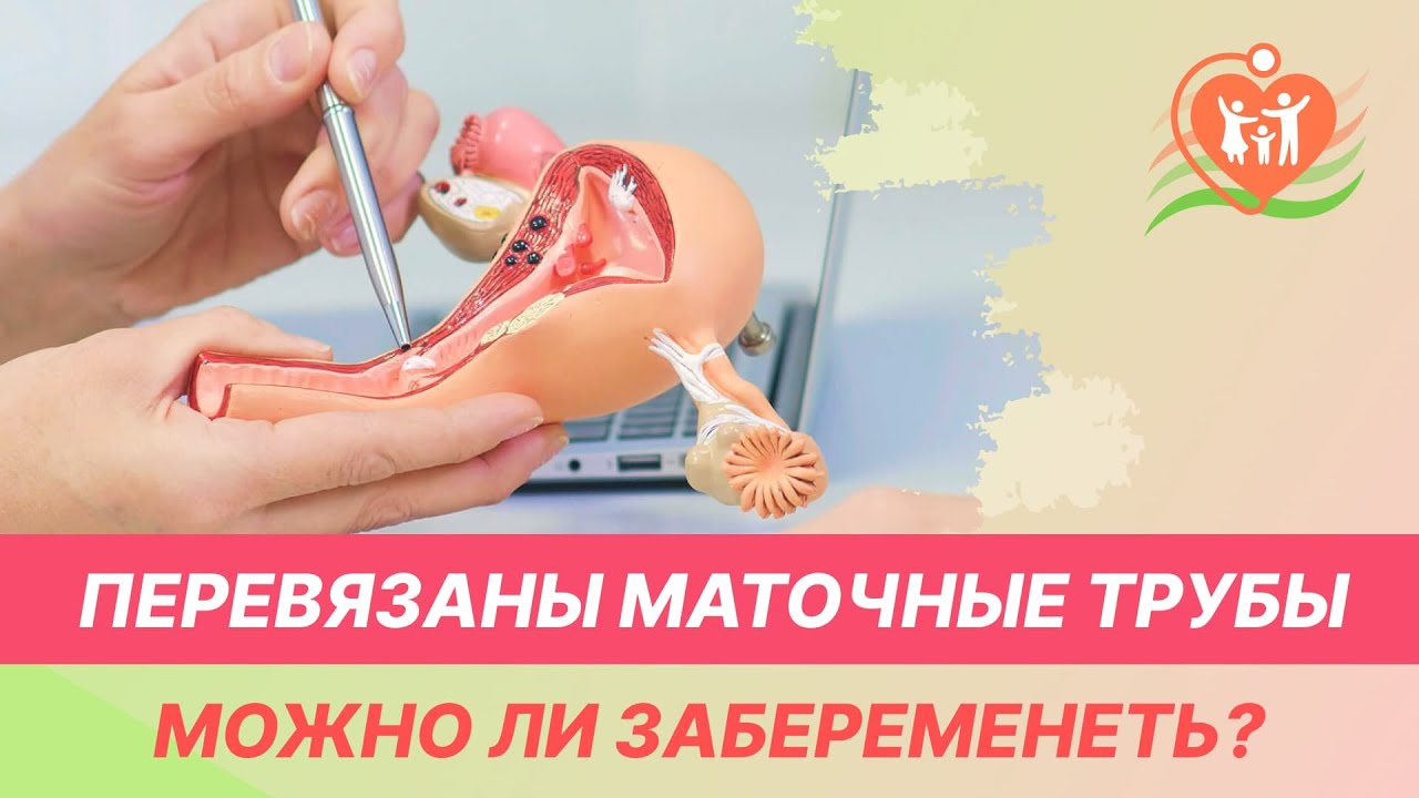 💁‍♀️ Перевязаны маточные трубы - можно ли забеременеть?