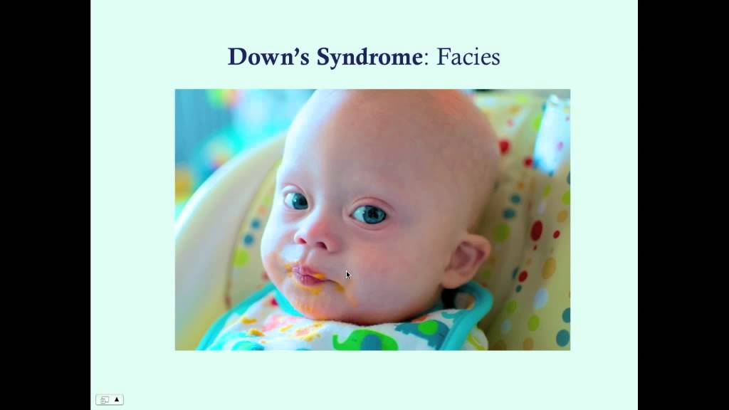Downs Syndrome - CRASH! Medical Review Series